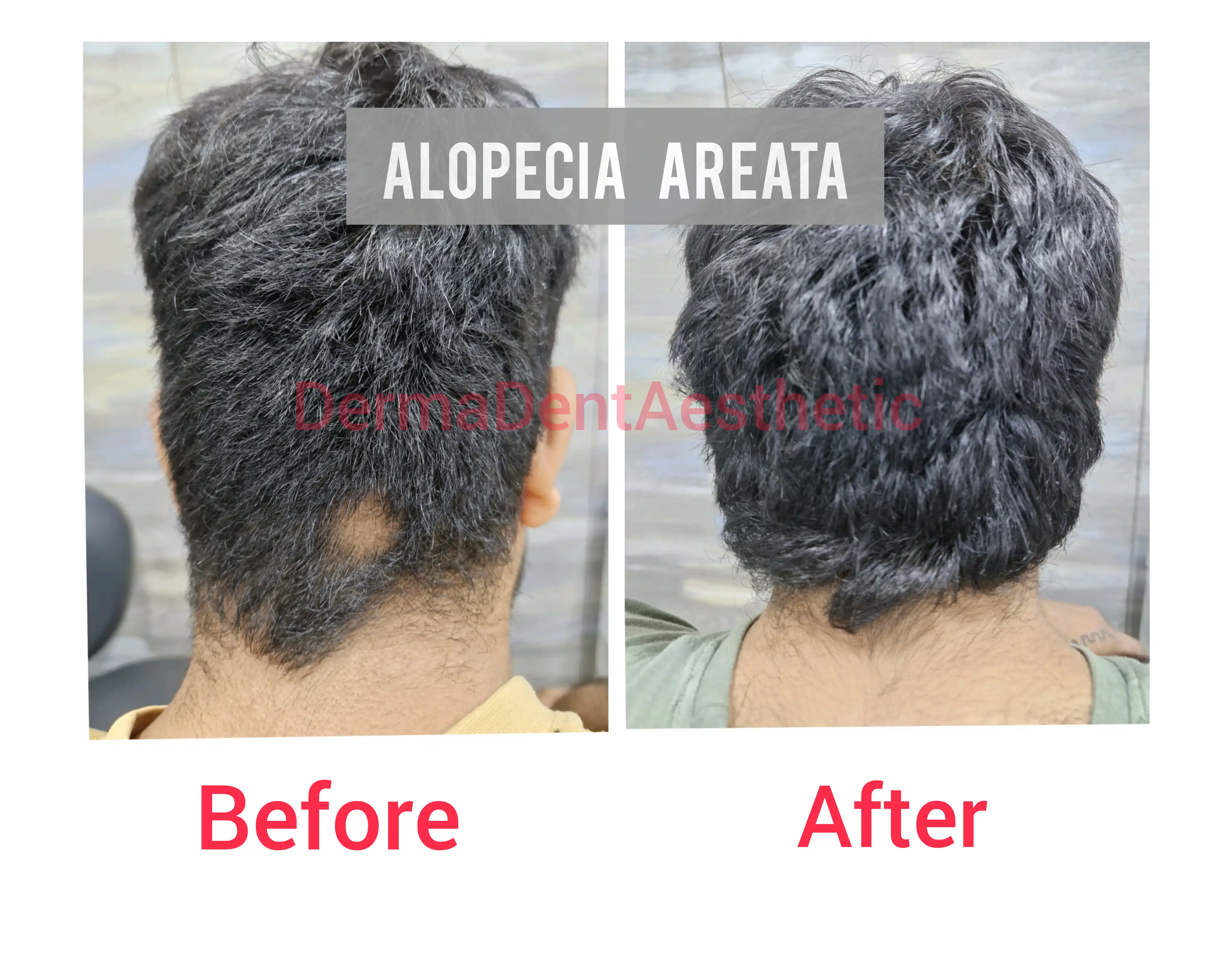 Alopecia_Areata