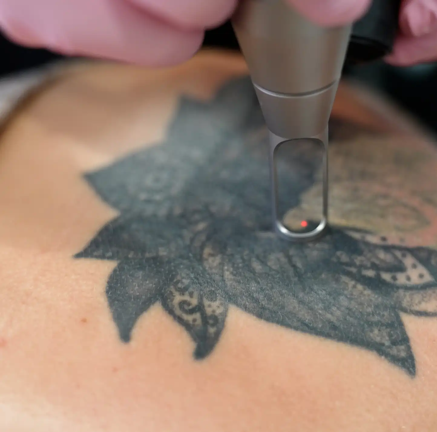 Laser-Tattoo-Removal