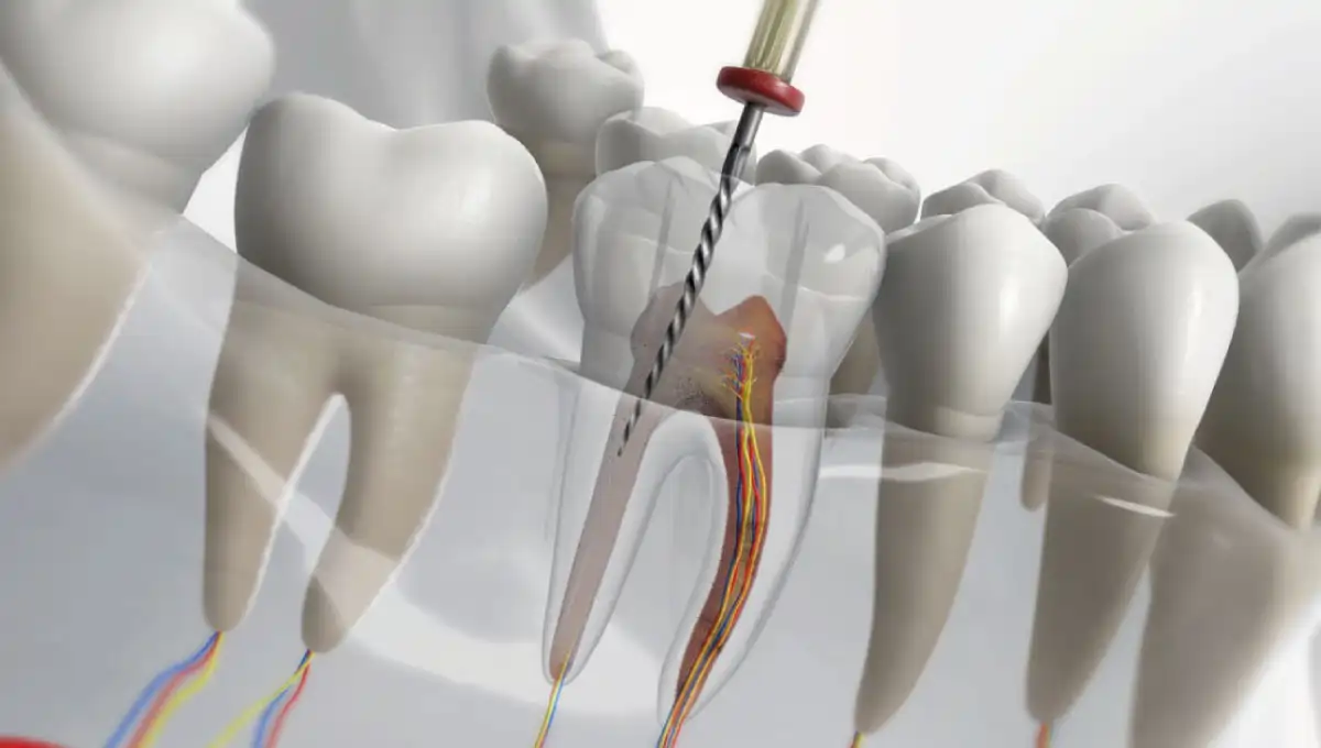 Root-Canal-Treatment-Steps