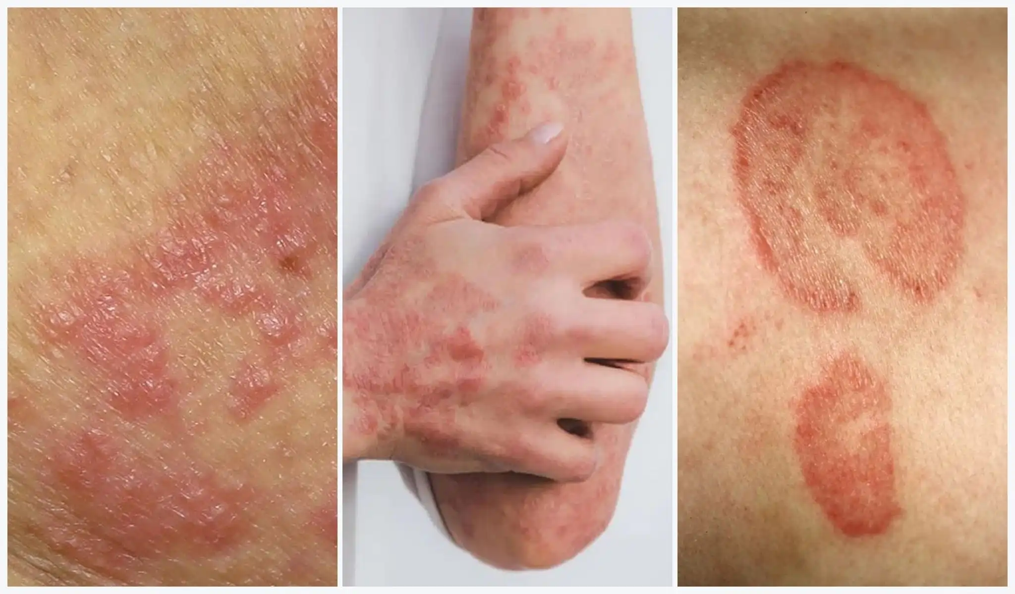 Skin-infections