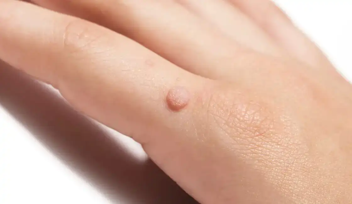 Warts-Removal