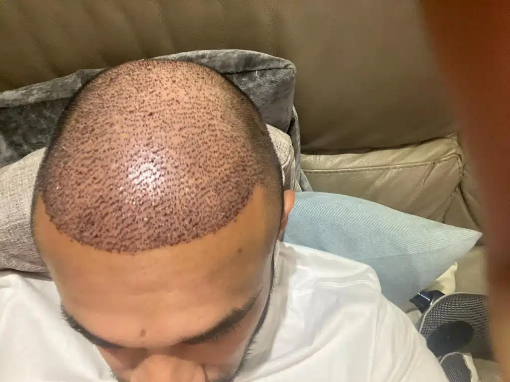 hair-transplant-main