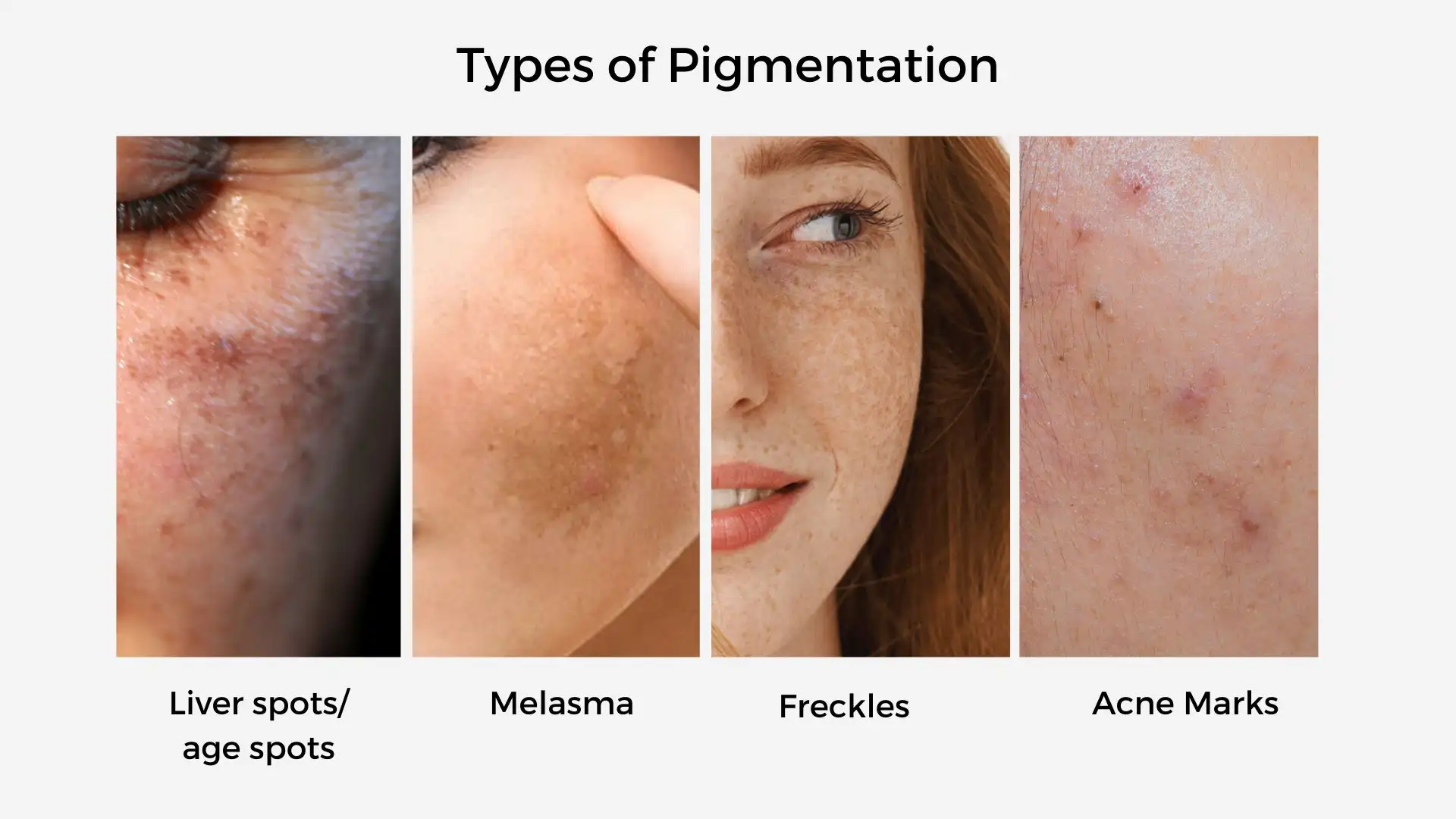 skin-pigmentation-types